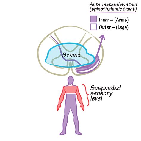 Neuroanatomy Glossary Suspended Sensory Level Ditki Medical