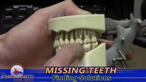 Smilecast Missing Teeth Finding Solutions Youtube