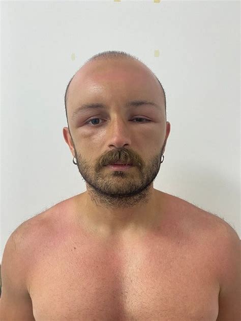 Man Develops Swollen Head After Day At The Beach Stuns Docs