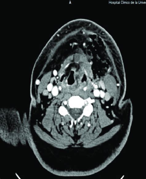 Ct Scan Of Cross Section Of Head And Neck Download Scientific Diagram