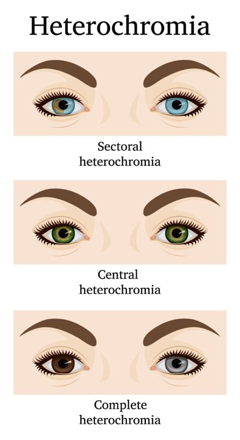 Central Heterochromia 2 Eye Colors Causes And Treatments