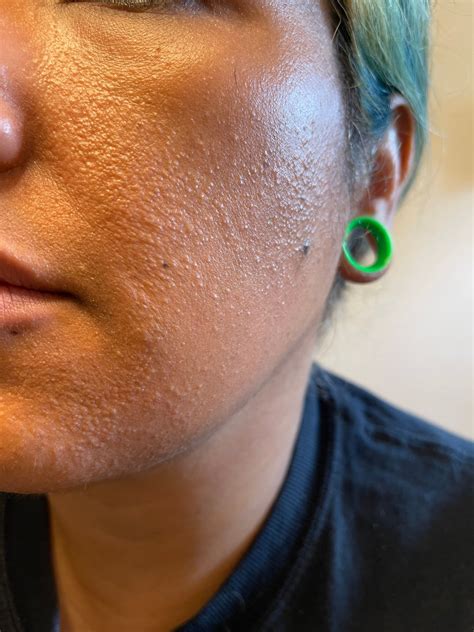 Small Rash Like Bumps All Over Face Beauty Insider Community