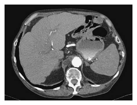 Ct Scan Showing Nodular Liver Contour Indicative Of Early Hepatic