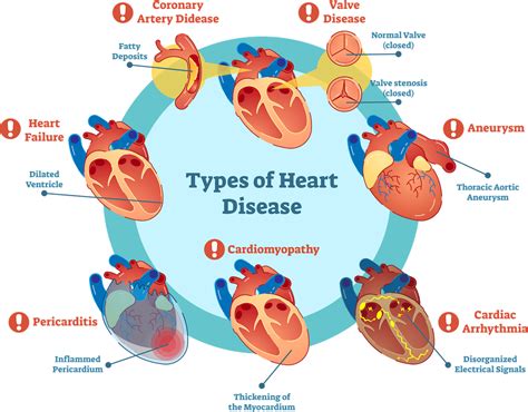 Heart Disease Stroke And Other Cardiovascular Diseases Its Your
