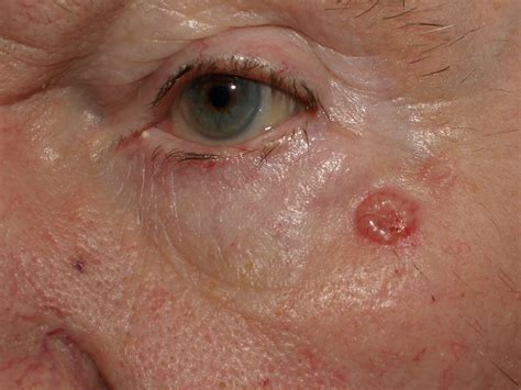 Basal Melanoma Skin Cancer