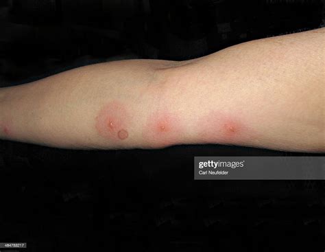 Bed Bug Bite Blisters Stock Photo Getty Images