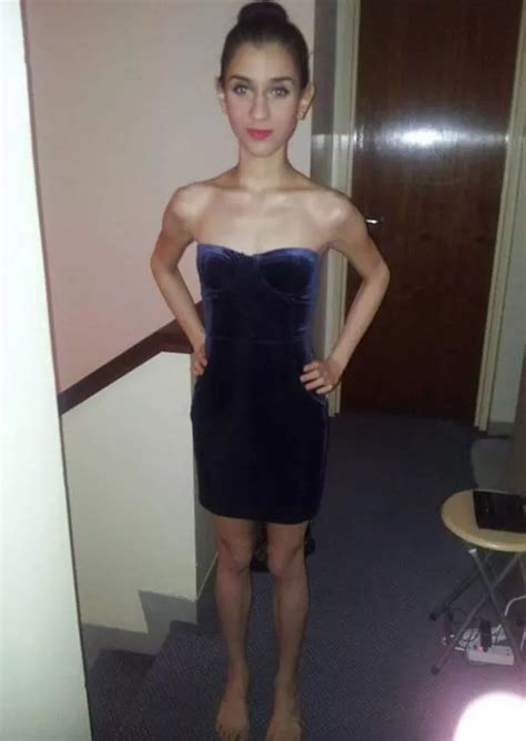 Astonishing Recovery Of Anorexic Girl Who Was Stone When Free