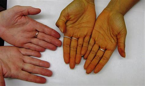 Hypothyroidism Symptoms May Include Carotenemia On The Palms And