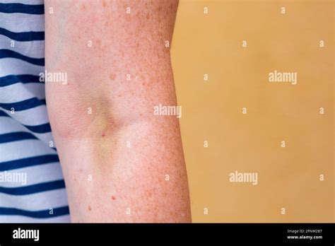 Hematoma Hi Res Stock Photography And Images Alamy