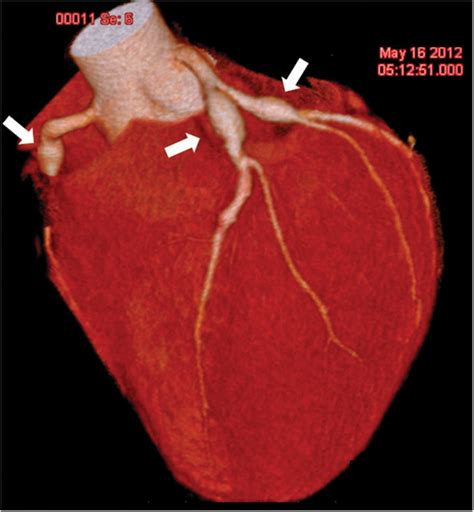 Coronary Artery Aneurysms After Adult Onset Kawasaki Disease Circulation
