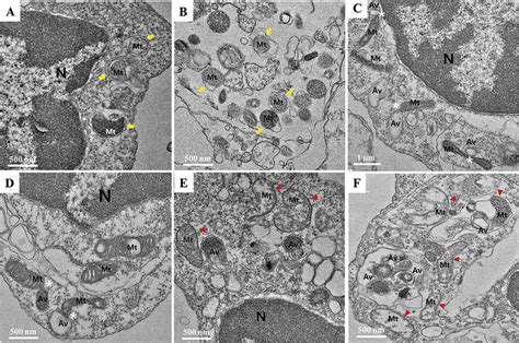 Transmission Electron Microscopy Images Of Mitochondria With Abnormal