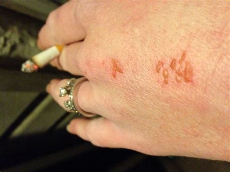 Maybe you would like to learn more about one of these? Carpet Beetle Dermatitis Images | www.resnooze.com