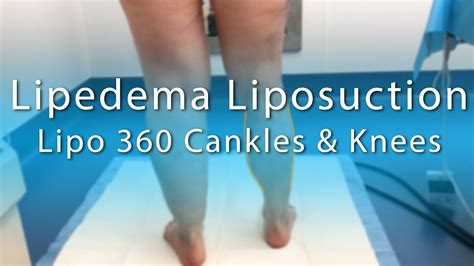 Lipedema Leg Liposuction Surgery Results Lipo 360 Cankles And Knees