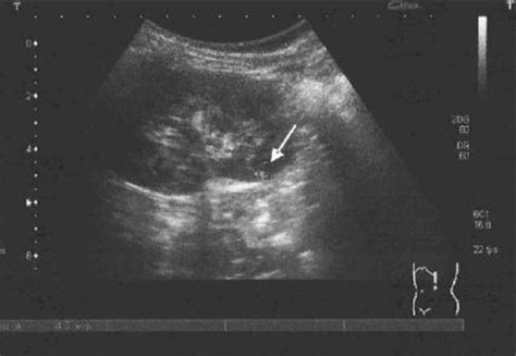Ultrasound Of Solitary Renal Aml Open I