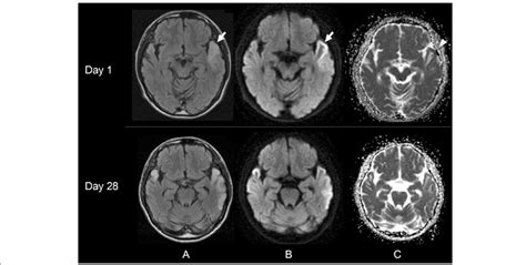 Brain Mris Obtained 14 Days After The Onset Of Initial Symptom A Brain