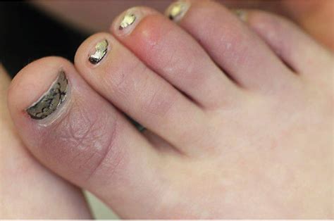 Teenage Girl With Painful Swelling On Toes Consultant360