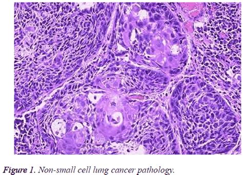 For these and other reasons, treatment for small cell lung cancer usually. What is non-small cell lung cancer? - Quora