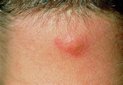 Close Up Inflamed Sebaceous Cyst On Male Neck Photograph