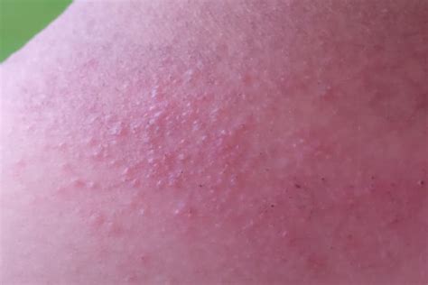 Rash 36 Common Skin Rashes Pictures Causes And Treatment