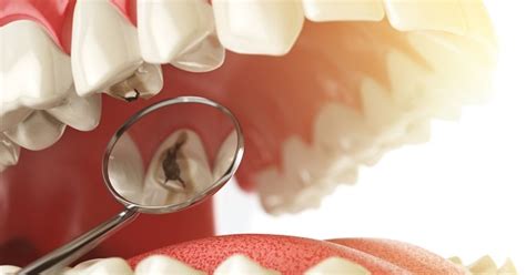 Lo Que Debes Saber Sobre Las Caries