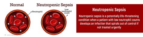 Neutropenic Sepsis Chemotherapy Associated Infection