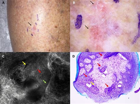 Recurrent Basal Cell Carcinoma Bcc 2 Years After Treatment With