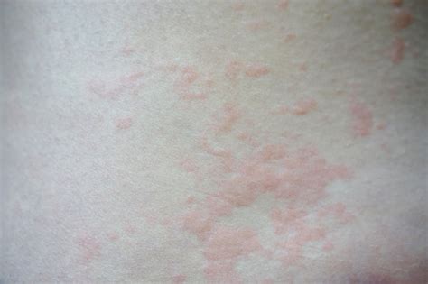 Hives Also Known As Urticaria Is A Kind Of Skin Rash With Red Raised