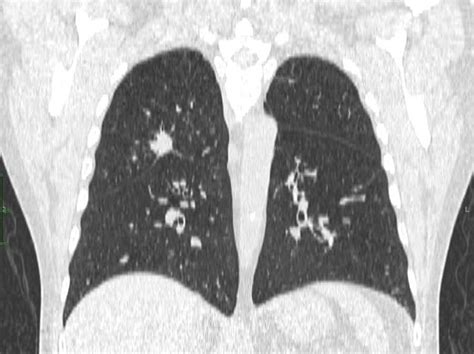 Right Upper Lobe Lung Mass X Rays Case Studies Ctisus Ct Scanning