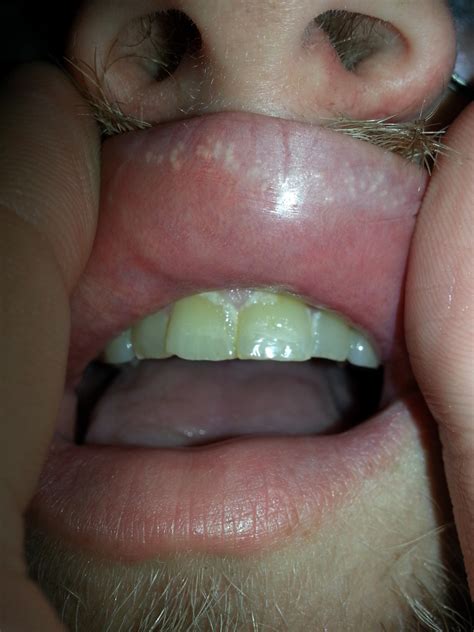 White Dots In The Inside Of My Upper Lip