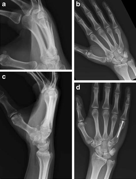 A B Preoperative Radiographs Of A Fifthmetacarpal Neck Fracture Cd Download Scientific Diagram