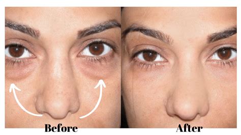 Fat Injections Under Your Eyes How To Do It Right