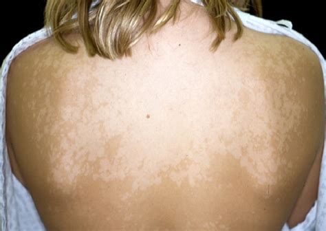White Spots On Skin Causes Pictures Treatment Symptoms Healthmd
