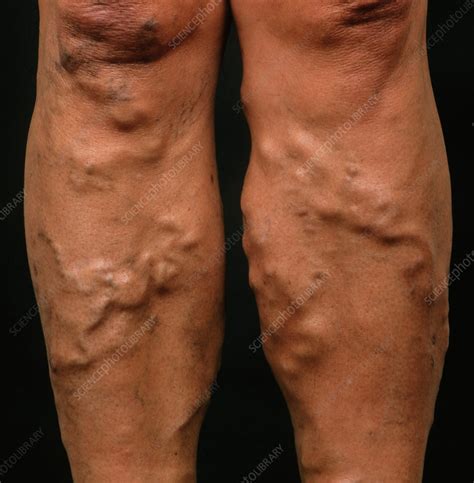 Varicose Veins On A Woman S Legs Stock Image M290 0054 Science Photo Library