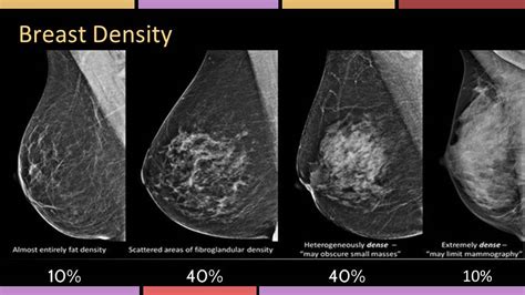 Area Of Density On Mammogram Doctorvisit