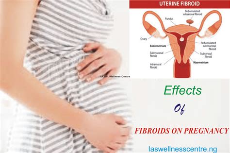 How To Get Pregnant With Fibroids