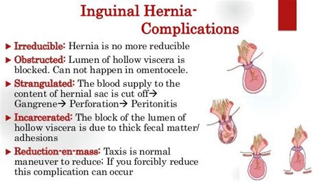 Inguinal Hernia Groin Swellings