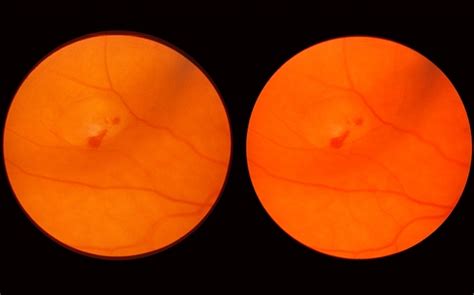 Scleral Indentation Retina Image Bank