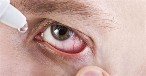 ojos secos síntomas causas y cómo tratarlos