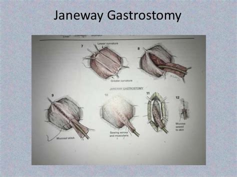 Seminar On Stamm Janeway And Pe Gastrostomy