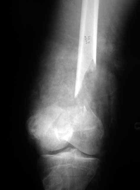 Open Distal Diaphyso Metaphyseal Femoral Fracture With 11 Cm
