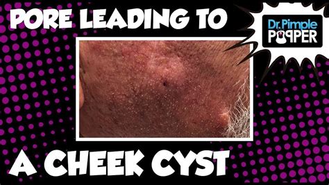 A Pore Leading Into A Cheek Cyst Youtube