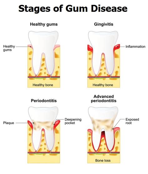Home Remedies For Gum Disease News Dentagama