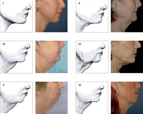 2 Evaluation Of The Anatomy And Aging Related Changes Of The Neck