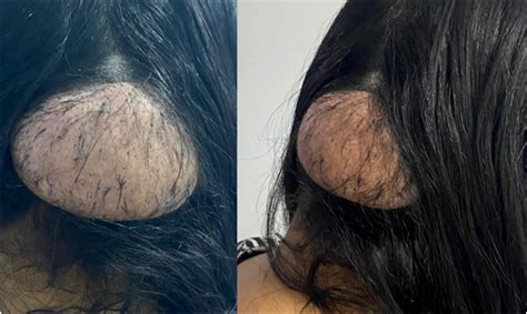 Scielo Brasil Atypical Cutaneous Presentation Of Tuberous Sclerosis Complex Giant
