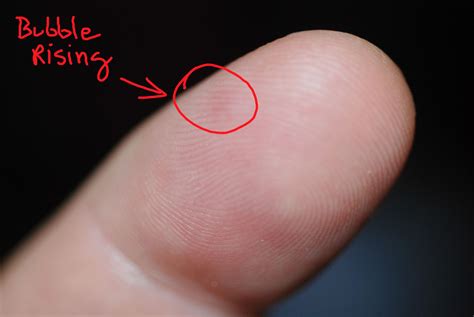 Eczema On Index Finger Index Finger