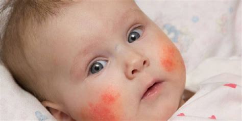 Does My Baby Have Eczema Daily Nutrition News