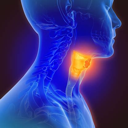 Throat cancer is often grouped into two categories: 3d Illustration Of Throat Cancer Stock Photo - Download ...
