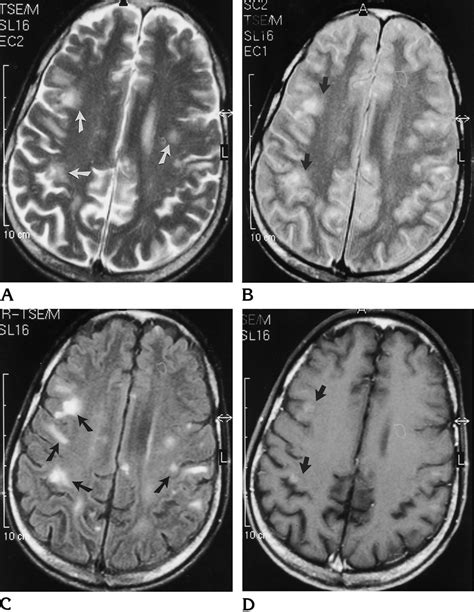 Cerebral Toxoplasmosis In A Patient With Aids A And B Depiction Of