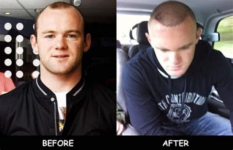 Wayne Rooney Hair Transplant Before And After Hairline Wayne Rooney Hair Transplant Hair