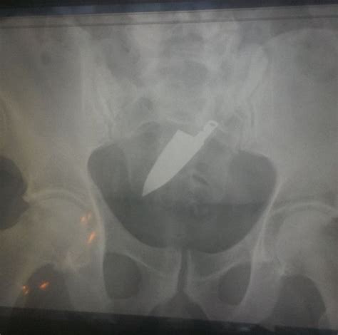 11 Weird Things Doctors Have Found Stuck In Peoples Butts Huffpost Uk